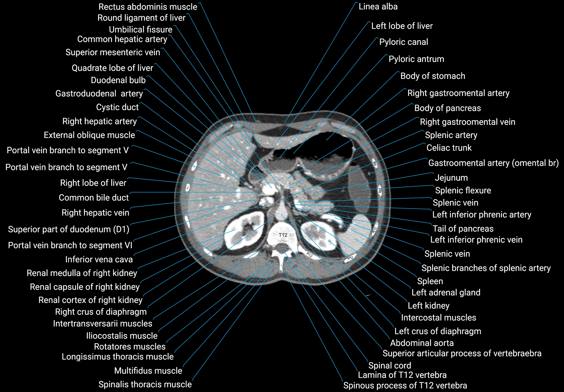 CT male pelvis axial cross sectional anatomy labelled radiology image -00046.webp